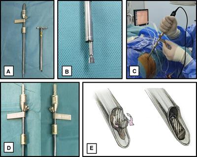 Modified lumbar foraminoplasty using a power-aided reciprocating burr for percutaneous transforaminal endoscopic lumbar discectomy: A technical note and clinical report